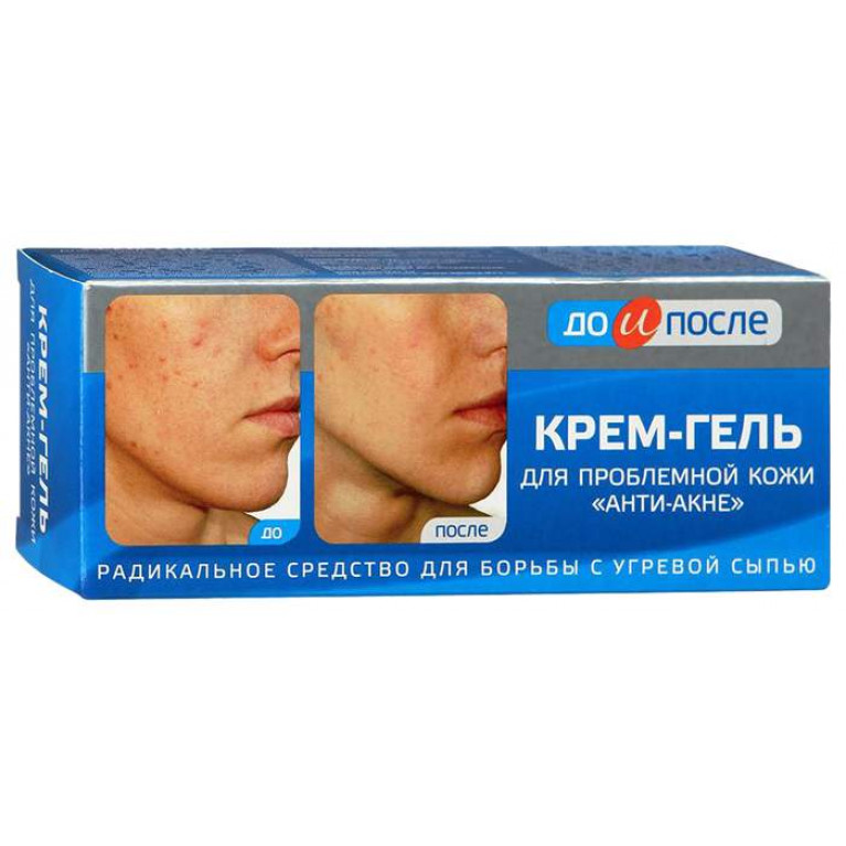До и после Анти-акне крем гель для проблемной кожи 50 мл